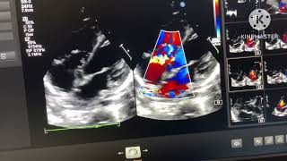 PM VSD with Gerbode Defect [upl. by Mira]