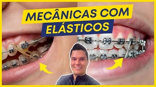 ELÃSTICOS ORTODÃ”NTICOS PRINCIPAIS INDICAÃ‡Ã•ES E EFEITOS NOS DENTES [upl. by Brendon]