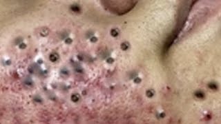 Satisfying Removal Blackheads amp Whiteheads 1029 [upl. by Kolb]