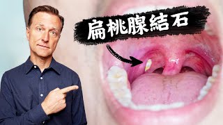 扁桃腺結石原因及預防自然療法柏格醫生 Dr Berg [upl. by Malliw171]