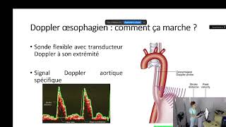 Monitorage hémodynamique du patient en fibrillation atriale au bloc opératoire [upl. by Haliehs961]