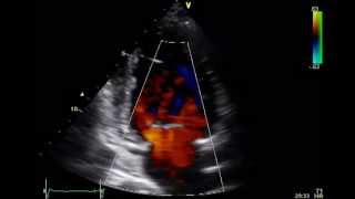 ECHO LEARNING GUIDE COMPLETE ECHOCARDIOGRAM DOPPLER ULTRASOUND [upl. by Lavotsirc]