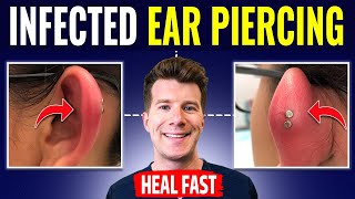 Doctor explains HOW TO RECOGNIZE AND TREAT INFECTED EAR PIERCING [upl. by Quiteria380]