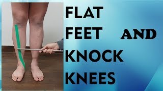 How Flat Feet Can Damage Feet Knees amp Hips How You Can Stop It [upl. by Philina263]