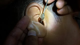 Fully blocked Ear Wax Removal [upl. by Vogeley]