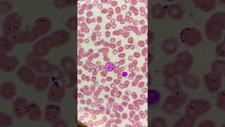 Malaria parasite under microscopePlasmodium vivax trophozoite ring and gametocytesmicroscopy [upl. by Yetah]