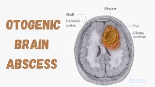 Otogenic Brain Abscess  Intracranial Complication Of Suppurative Otitis Media [upl. by Chuch]