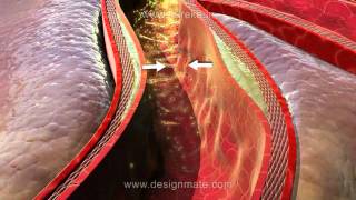 Assista a aula sobre Aterosclerose simulada na nova Lousa 3D Estereoscópico [upl. by Diana]