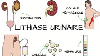 LITHIASE URINAIRE Signes et Symptômes diagnostic traitement  Complications [upl. by Airotciv345]