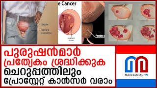 പുരുഷന്‍മാരുടെ ശ്രദ്ധക്ക് പ്രോസ്റ്റേറ്റ് കാന്‍സര്‍ ചെറുപ്പക്കാരിലും പിടിമുറുക്കുന്നു [upl. by Corabel472]