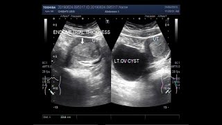 Ultrasound Video showing Large Lt Ovarian Cyst and Endometrial hyperplasia [upl. by Magda]