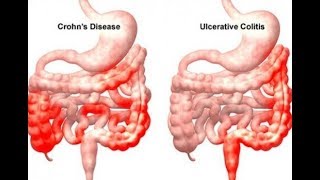 Ulcerative colitis Symptoms  Causes Signs and Symptoms of Ulcerative Pancolitis [upl. by Nylirem]