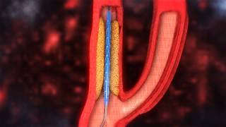 Carotid Artery Stenting video [upl. by Carrel]