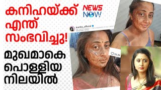 കനിഹയ്ക്ക് ഇതെന്തു പറ്റി മുഖമാകെ പൊള്ളിയ നിലയില്‍ kaniha movie actress [upl. by Gale]