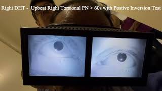 Right Posterior Semicircular Cupulolithiasis with Positive Inversion Test [upl. by Ailyt119]