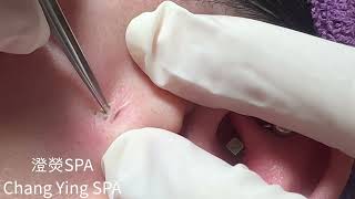 桃園中壢清粉刺 臉頰黑頭清除 Blackheads on face Removal！ [upl. by Nurav75]