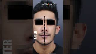 Facial Asymmetry Correction  Good Facial Appearance  Best Facial Plastic Surgeon in Kerala [upl. by Boykins]