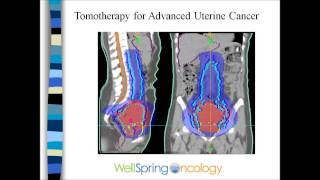 Radiation and Endometrial Cancer [upl. by Nerti544]