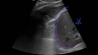 POCUS  Lung Ultrasound Understanding B Lines and Hepatization [upl. by Bahner]