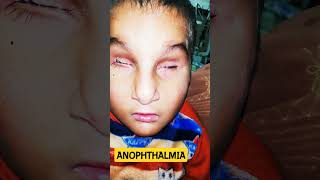 Anophthalmia [upl. by Atiram]