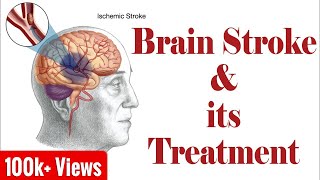 Ischemic Brain Stroke amp Haemorrhagic Brain Stoke Treatment [upl. by Adelaja]