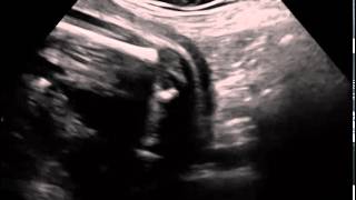 Ultrasound in Obstetrics amp Gynecology A Practical Approach  Clip 32 [upl. by Brout792]