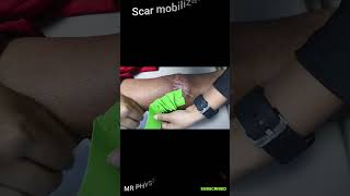 Scar mobilization with taping physio doctor kneepainrelief viralshorts trending treatment [upl. by Hittel]