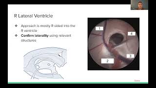 Surgical Management of Hydrocephalus Secondary to Posterior Fossa Tumors by Ben Rodriguez [upl. by Tarton]