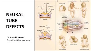 Neural Tube Defects Lecture [upl. by Anaitsirhc]