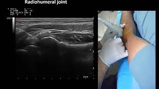 Ultrasound guided elbow radiohumeral joint injection by Prof Murat Karkucak MD [upl. by Shayn]