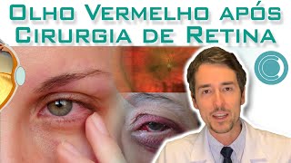 Como Aliviar Irritação nos Olhos Por Causa da Máscara [upl. by Vary]