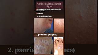 Dermatological signs papules acne acnetreatment psoriasis plaques [upl. by Drida84]