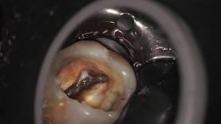 ”Red Russian Cement” endodontic retreatment of an upper molar [upl. by Dutchman]