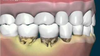 Tartaro e formazione di tasca subgengivalewmv [upl. by Trauner]