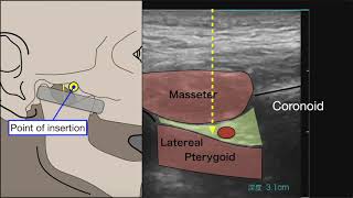 Maxillary  inferior alveolar nerve blocks for gnathoplasty [upl. by Dannel]