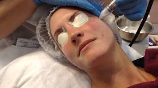 Microdermabrasie behandeling van reviderm [upl. by Harras]