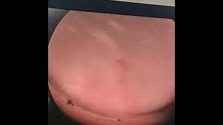 cystoscopy of common cloaca of 7 years female child with covering colostomy [upl. by Aeslehc]