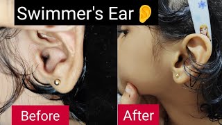 What is Swimmers Ear Ear Pain Treating Swimmers Ear  Treating Swimmers Ear rid of swimmer’s ear [upl. by Patrica295]