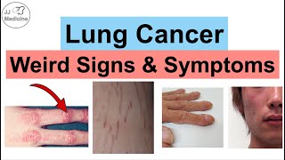 Lung Cancer Weird Signs and Symptoms  Paraneoplastic Syndromes of Lung Cancer [upl. by Nnire]