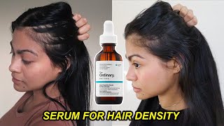 I tried The Ordinary Serum for Hair Density for 4 months amp THIS HAPPENED  Before and after results [upl. by Melton970]