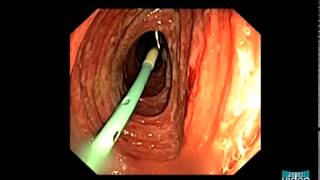 Vascular Lesions in the Small Bowel [upl. by Mairim]