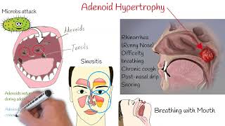 Adenoid Hypertrophy  If your kid sleeps with open mouth you should watch this video [upl. by Rosemary]