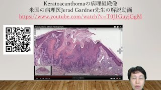 keratoacanthomaの病理組織像 [upl. by Demp838]