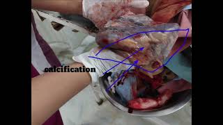 calcification of plecenta  midwifery nursingofficer mbbs education [upl. by Georgianne]