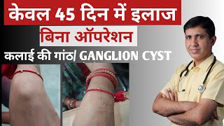 Homeopathy For Ganglion Cysts  A Natural Drugfree Way To Treat These Growths [upl. by Bax842]