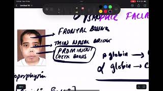 THALASSEMIA  PATHOLOGY  MBBSNEETPG INICET FMGE PREP HEMATOLOGY [upl. by Nuhsar]