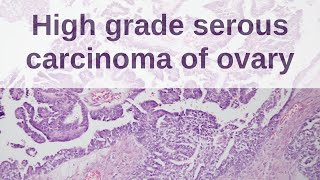 High Grade Serous Carcinoma of Ovary  Pathology mini tutorial [upl. by Fan]