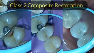 Composite Restoration of Class 2 Cavity in Upper Premolar  Posterior Composite Filling [upl. by Kaine]