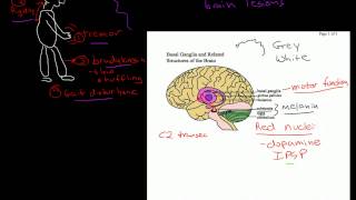 Parkinsons Dementia [upl. by Aiht]