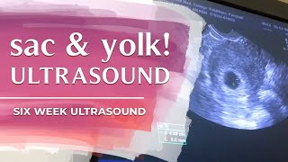 6 week ultrasound  sac and yolk [upl. by Nohsram]